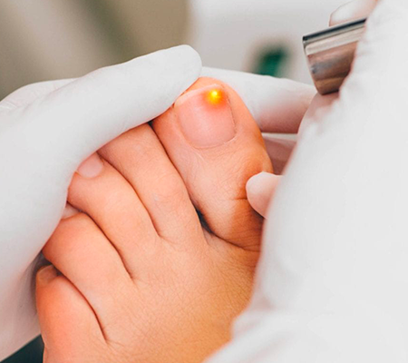 Laser Toe Fungus Removal